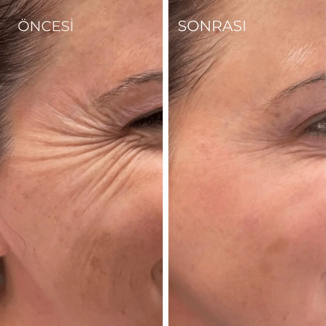 Korenlea™ Medikal Beauty Kolajen Bandı